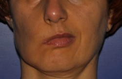 Long-standing facial paralysis on the right side of the face: asymmetry of features at rest.