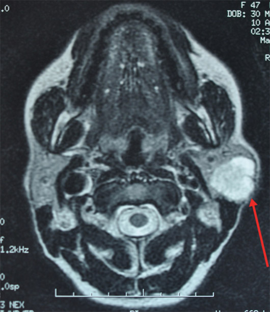 MR image shows a giant pleomorphic adenoma (~5 cm in diameter) of the left parotid.