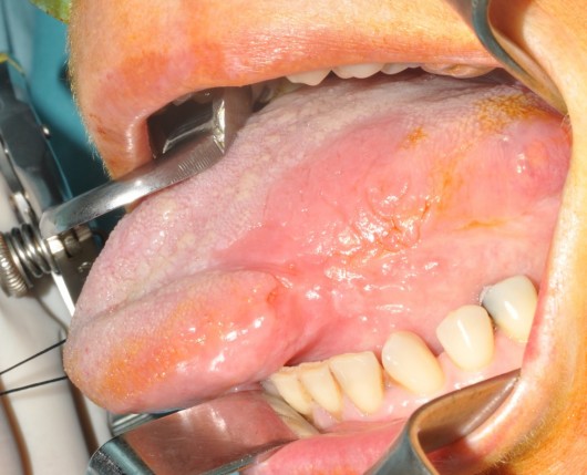 Carcinoma squamocellulare del margine linguale