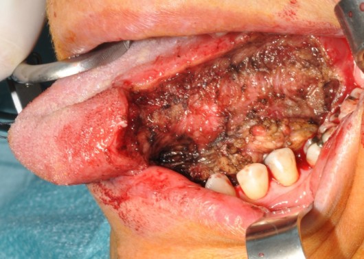Wide excision of lingual tissues at the end of tumour removal.