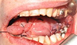 The tongue immediately after microsurgical reconstruction.