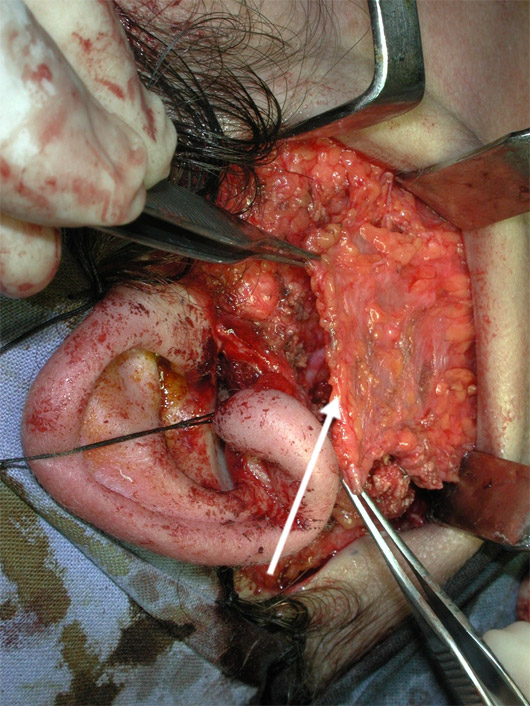 The thin parotid fascia and the underlying superficial musculoaponeurotic system (SMAS) are held with forceps so as to transpose them at the end of surgery to prevent the onset of Frey syndrome.