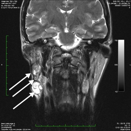 Risonanza magnetica di paziente affetta da multiple recidive di adenoma pleomorfo (frecce). Dopo ripetuti interventi, al fine di asportare radicalmente le lesioni si rende necessaria l’asportazione dell’intera ghiandola parotide unitamente al nervo facciale ed alle sue diramazioni.