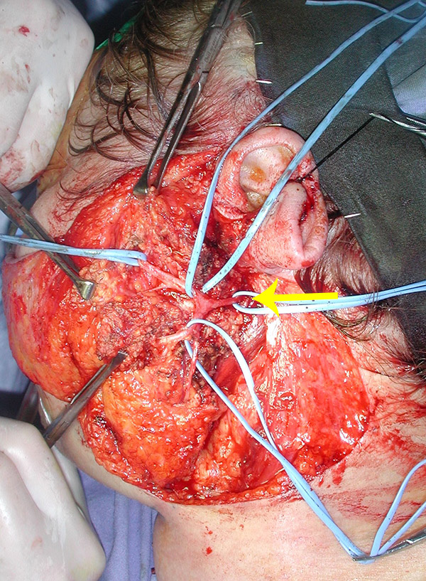 Intraoperatoriamente viene isolato il tronco del nervo facciale (freccia) e tutte le sue diramazioni (fettuccie blu)