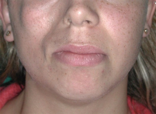 Paziente affetta da Sindrome di Romberg (atrofia emifacciale) che comporta grave asimmetria di sviluppo tra le due metà della faccia.