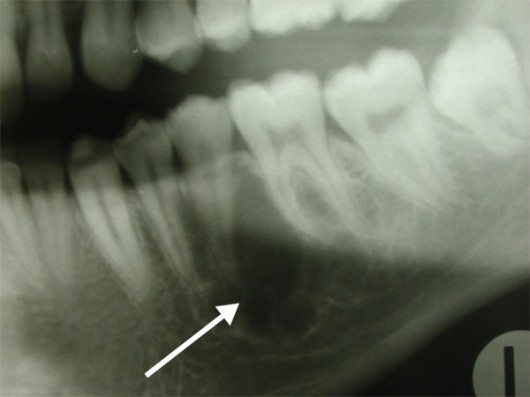 Mixoma odontogeno della mandibola