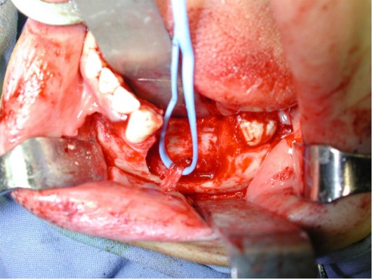 Al termine dell’asportazione della lesione esita una perdita ossea mandibolare che necessita di ricostruzione. La fettuccia azzurra sottende il nervo alveolare inferiore correttamente conservato