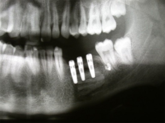 Panorex X-ray: three implants inserted into the grafted bone for prosthetic rehabilitation.