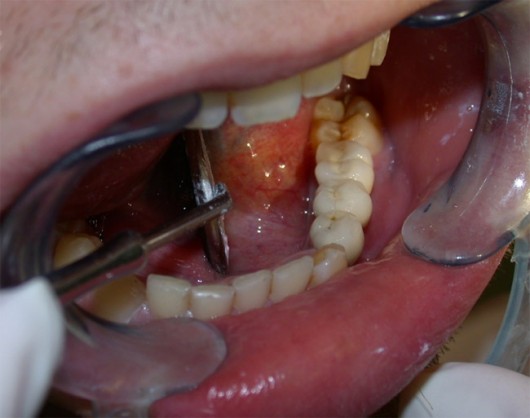 Lower dental arch at the end of the prosthetic rehabilitation.