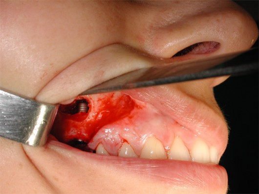 The implant (arrow) inserted into the maxilla immediately after sinus lifting.