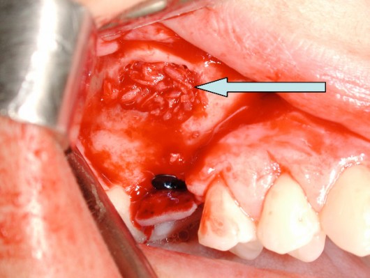 Bone “scratched” in the same surgical site is grafted (arrow) around the implant to ensure subsequent stability.