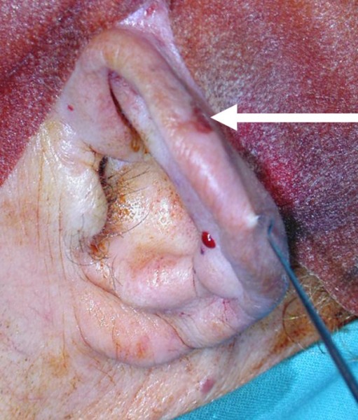 Carcinoma squamocellulare del padiglione auricolare (freccia). 