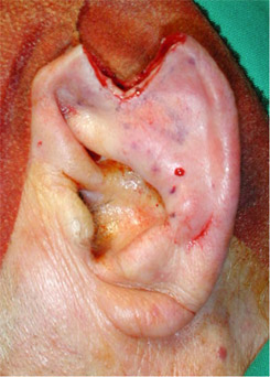 Ear appearance after wide removal of the lesion.