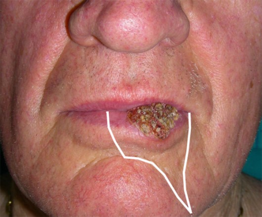 Carcinoma del labbro inferiore. Le linee di incisione sono disegnate per rendere la cicatrice quanto più naturale possibile.