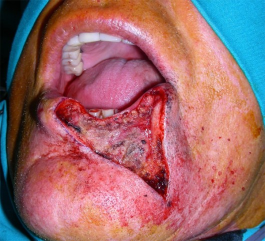 A wide portion of the lower lip was removed in the radical excision of the lesion.