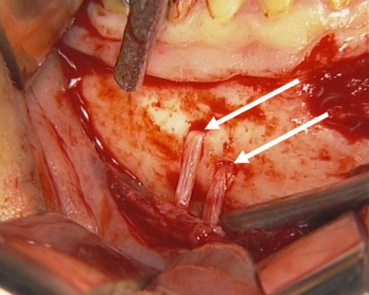 The unusual finding of a double mental foramen through which the mental nerve exited the mandible, providing sensitivity to the lower lip.