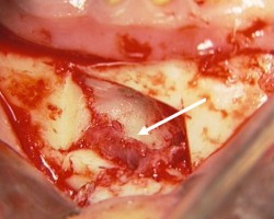 The intact inferior alveolar nerve (arrow) at the end of endodontic material removal.