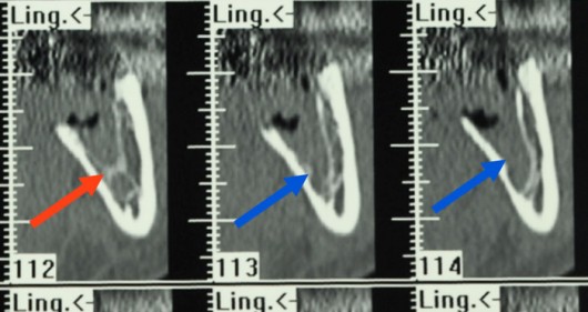 Lesion of the inferior alveolar nerve after wisdom tooth extraction. Note the thin bony septum (red arrow) separating the alveolus (seat of the tooth in the bone). A few millimetres behind (blue arrows), the destruction of the septum is evident, explaining the nerve damage. 