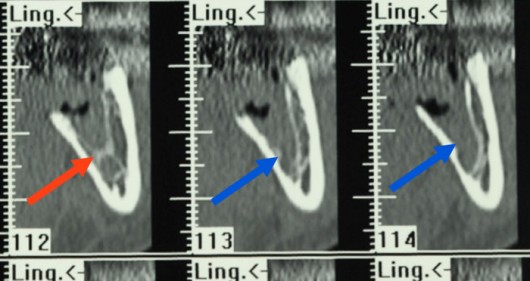 Lesione del nervo alveolare inferiore durante estrazione di un dente del giudizio: si noti il velo osseo (freccia rossa) che separa l’alveolo (cavità) dove alloggiava il dente prima dell’estrazione. Pochi millimetri più dietro si evidenzia (frecce blu) la distruzione del setto che ha procurato la lesione nervosa. 