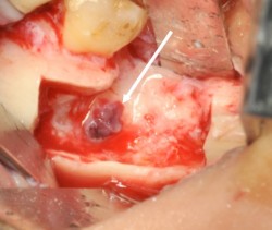 The point of the lesion of the inferior alveolar nerve is highlighted by the arrow after removal of the upper bone. 