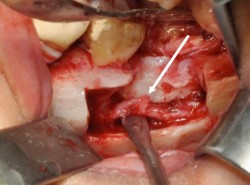 The nerve lesion (arrow) is more evident after removal of the surrounding bone. The nerve will later be smoothed under microscope visual control.