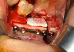 The bone surgical site reconstituted at the end of the microsurgical step. 