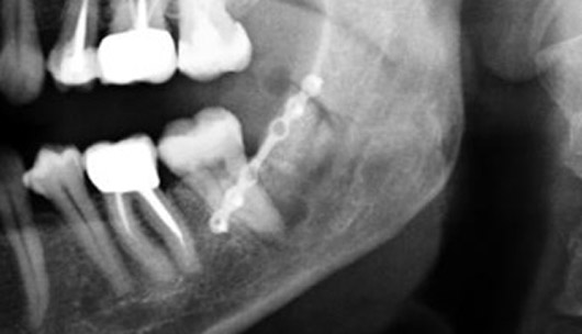 Panorex X-ray of the mandible immediately after surgery.