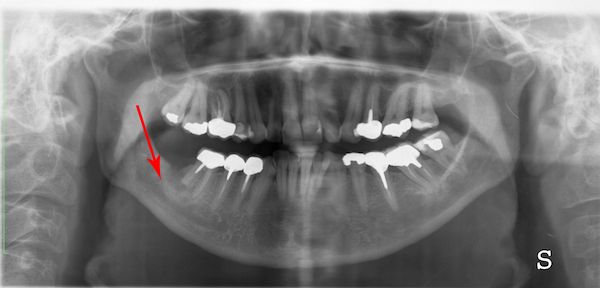 paziente che prova dolori violenti successivamente ad estrazioni dentarie mandibolari destre che hanno comportato la lesione del nervo alveolare inferiore
