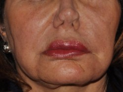 pa2 Good symmetry of features at rest post-operatively.