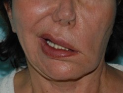 pa3 Worsening of the asymmetry during pre-operative smiling.