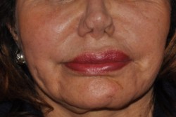 pa4 Symmetrical smile after surgery.