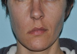 Asimmetria del labbro superiore di grado medio a riposo 
