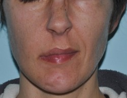 Lip motility deficit with lip dragging towards the left is evident when smiling.