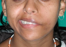 PRIMA - La paresi si evidenzia a carico del labbro superiore, meno a livello del labbro inferiore durante il sorriso