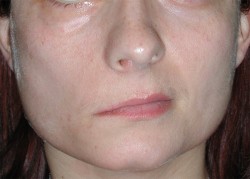 Medium-grade asymmetry of the upper lip at rest.