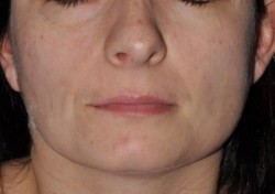 Symmetry of the face after surgery.