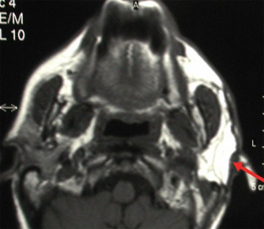 MRI 2 years after surgery shows ideal engraftment of the flap (arrow) and the fine reconstruction of the parotid region.