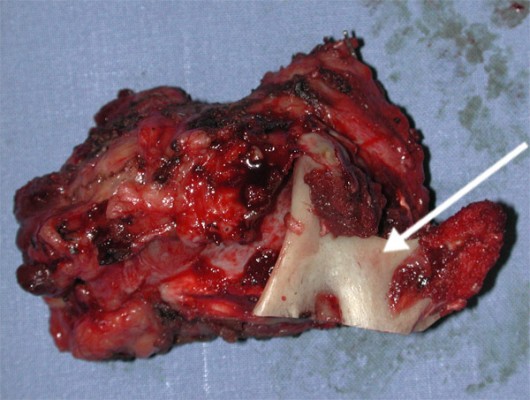 The need to radically remove the lesion resulted in the removal en bloc of the parotid gland, the mandibular branch (arrow), and facial nerve with its main branches.