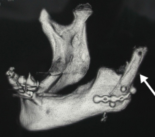 CT scan of the jaw reconstructed with a rib (arrow).