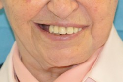 Symmetrical smiling 5 years after surgery.