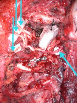 The facial nerve and its branches reconstructed with the thoracodorsal nerve and its branches (arrows).