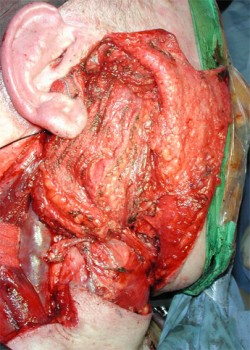 La regione parotidea viene ricostruita con un lembo microvascolare per evitare un antiestetico infossamento della parte operata dopo l’intervento