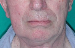 Morphology of the face correctly restored at 6 months after surgery.