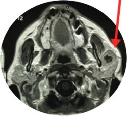 MRI demonstrates the wide extent of the lesion (arrow).