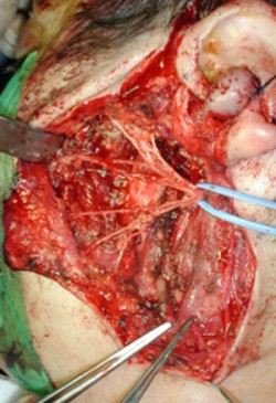 The facial nerve (subtended by the blue ribbon) and its branches held at the end of tumour removal.