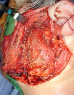 The parotid region was reconstructed with a microvascular flap to avoid an unsightly depression after surgery.